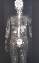 Full Body MRI